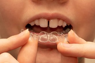 Invisalign used to fix gapped front teeth