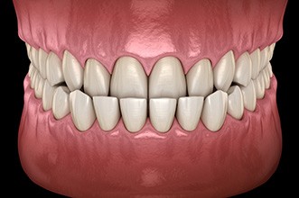 Illustration of an underbite