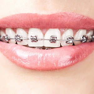 closeup of patient with traditional braces