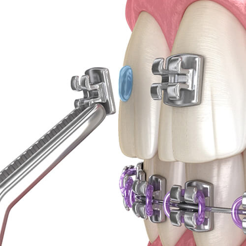Illustration of braces bracket being bonded to teeth