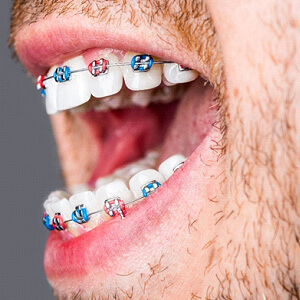 Dentist holding model teeth with traditional braces