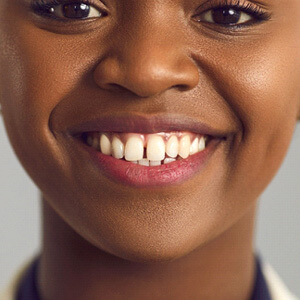 Dentist holding model teeth with traditional braces